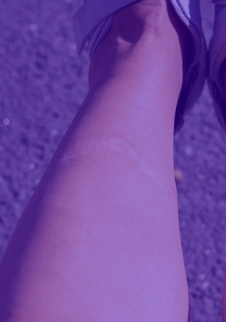 scar